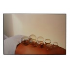 #35117 Cupping Therapy